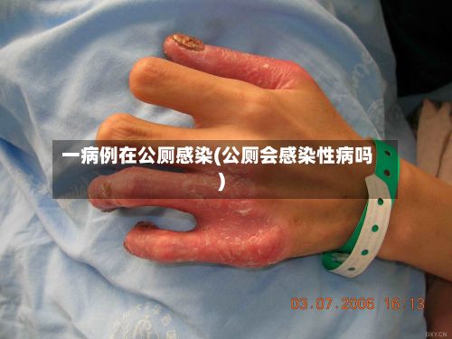 一病例在公厕感染(公厕会感染性病吗)