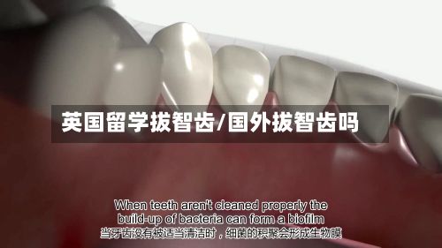 英国留学拔智齿/国外拔智齿吗-第3张图片