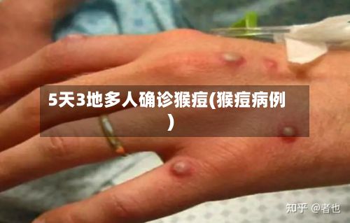 5天3地多人确诊猴痘(猴痘病例)-第3张图片